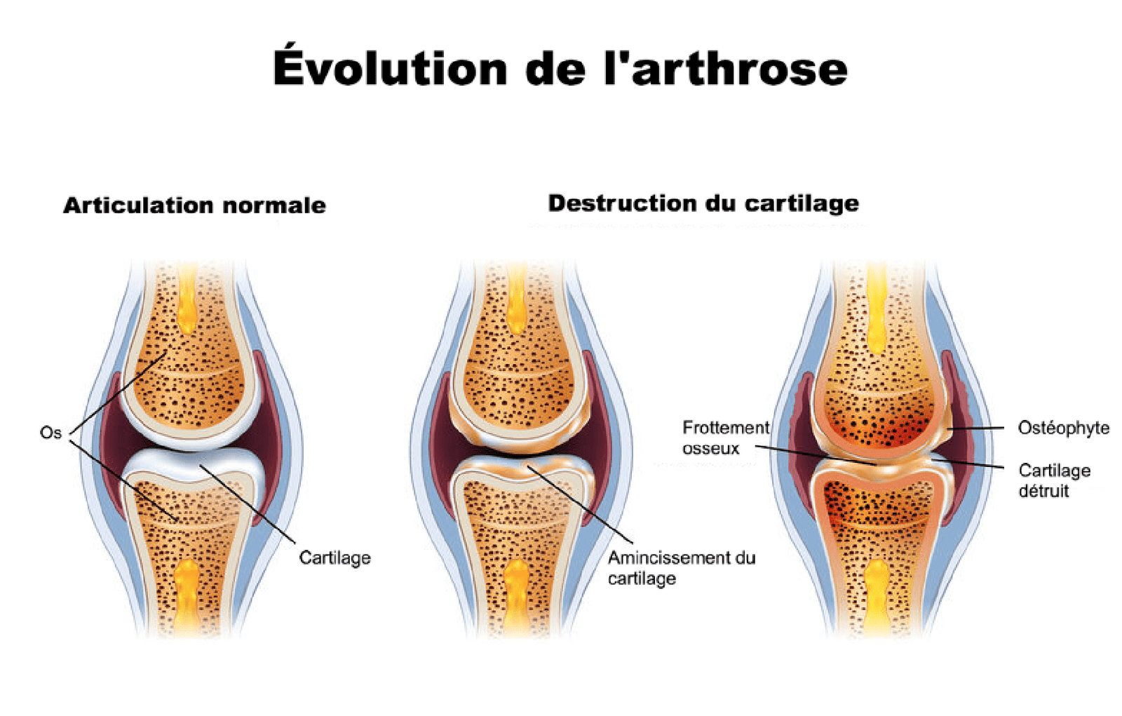 Évolution de larthrose