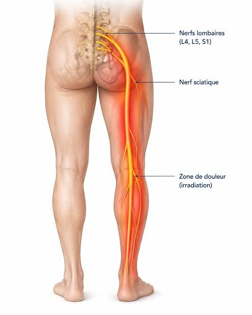 Trajet du nerf sciatique et irradiation douloureuse dans la jambe
